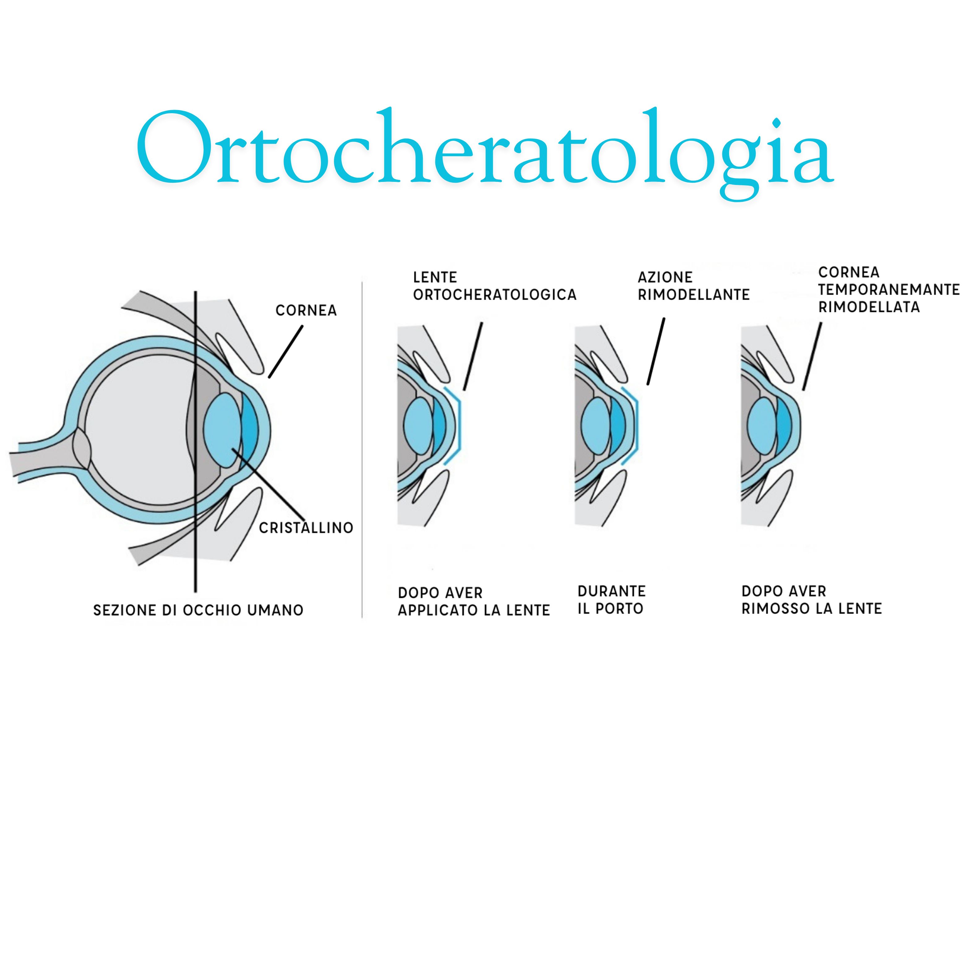 Pacchetto Ortocheratologia 