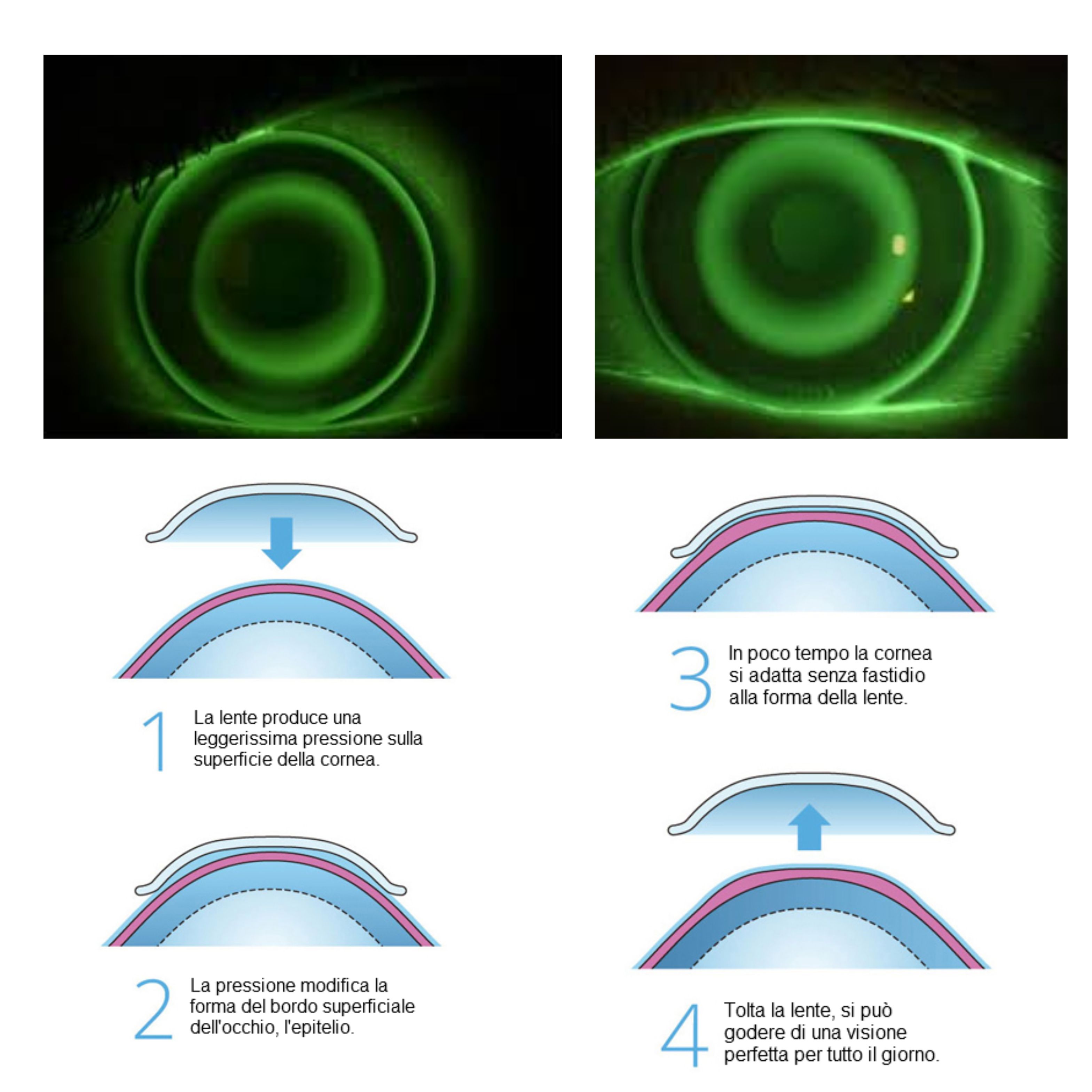 Ortoocheratologia lenti a contatto notturne ottica dieci decimi Napoli  Vomero